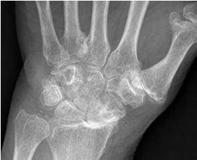 Variable osteophyte formation Hand and