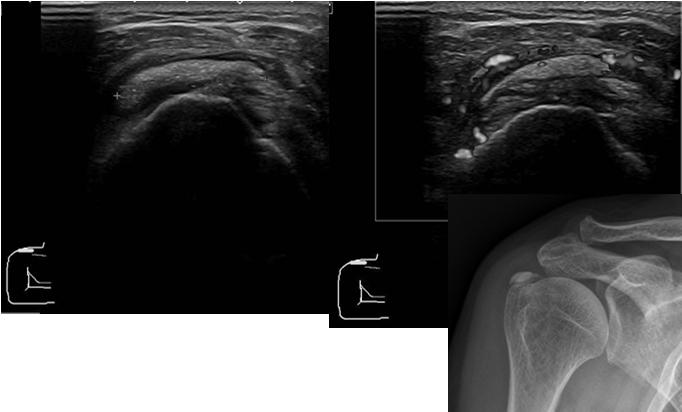 resolution of both clinical and imaging findings Acute calcific periarthritis 60% at shoulder joint (M/C) Second most common is hip (gluteus medius near greater