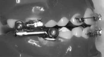 The purpose of this study was to investigate the condyle-fossa changes of Class II patients treated in the early mixed dentition period with the crowned Herbst appliance, and to examine the stability