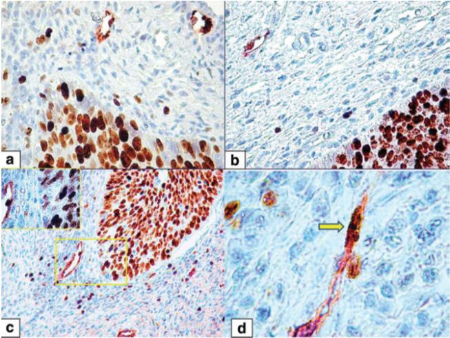 Shadow Keyplayers of the Uterine Cervix Lesions Progression and Metastasis 27 found between the proliferative status of lymphatic endothelial cells in both cervical intraepithelial neoplasia types.