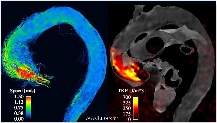 Turbulent flow at peak systole in the ascending aorta of a patient with a stented aortic valve prosthesis, measured by generalized phase-contrast MRI Left: 3D streamlines outline the instantaneous