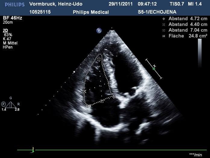 Echo findings and clinical course : Mildly impaired LV /RV function Severe Pulmonary