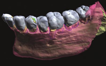 DENTAL ANATOMY DESCRIBE THE MOLAR RELATIONSHIP IN ANGLE S CLASS III MALOCCLUSION Occlusion Class III Occlusion Fully interactive, annotated, 3D models of the upper and lower arches of adult teeth in