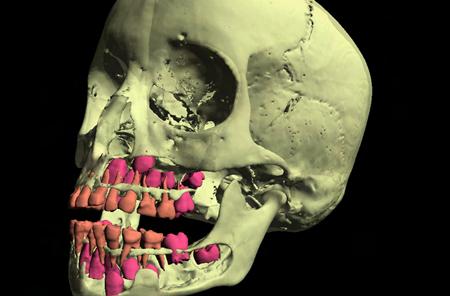 occurs in the maxilla and mandible.