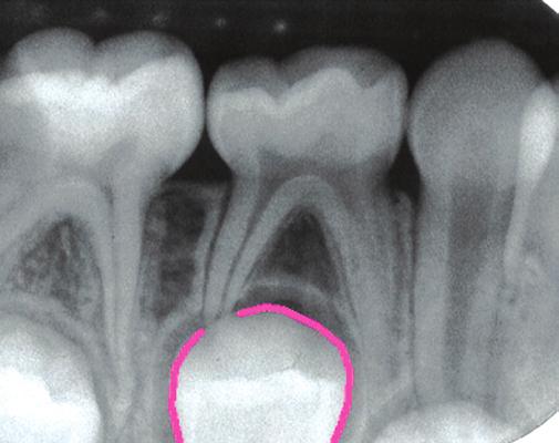 DENTAL RADIOLOGY Identify anatomical landmarks of deciduous teeth on a periapical radiograph, 20 Identify normal primary teeth and bone landmarks on a periapical radiograph, 20 Locate the deciduous