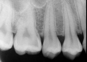 DENTAL ANATOMY LOCATE THE PERMANENT TEETH ON A PANOREX RADIOGRAPH Secondary Teeth Radiograph An interactive annotated X-ray introduces the name and location of anatomical structures.