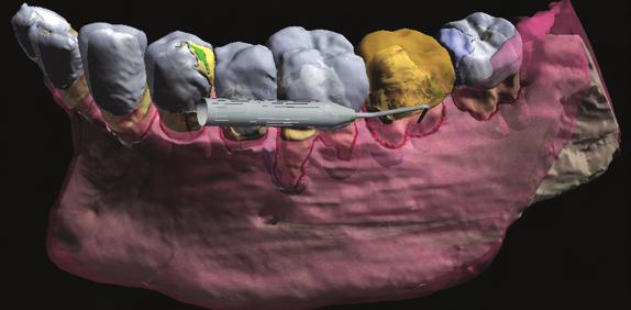 diagnosing periodontal disease, 26 3D model with: 1) User controlled transparency of teeth and their supporting structures, 2) Normal and pathological conditions, 3) Perioprobing demo.
