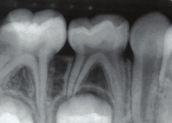 LEARNING OBJECTIVES Differentiate between periapical radiolucencies and radiopacities, 29 Identify pathological anomalies using dental radiographs, 30 IDENTIFY ANATOMICAL STRUCTURES X-Ray Database
