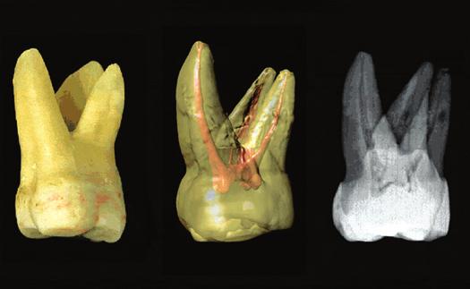 User-controlled simultaneous rotation of a tooth: 1) Photograph, 2) 3D surface model, 3) 3D X-ray and simultaneous view through CT and photograph slice data.