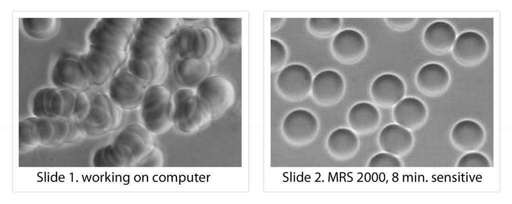 5.4 PEMF & Blood Viscosity 4. PEMF therapy lower Viscosity and Stickiness of Blood (Rouleau effect).