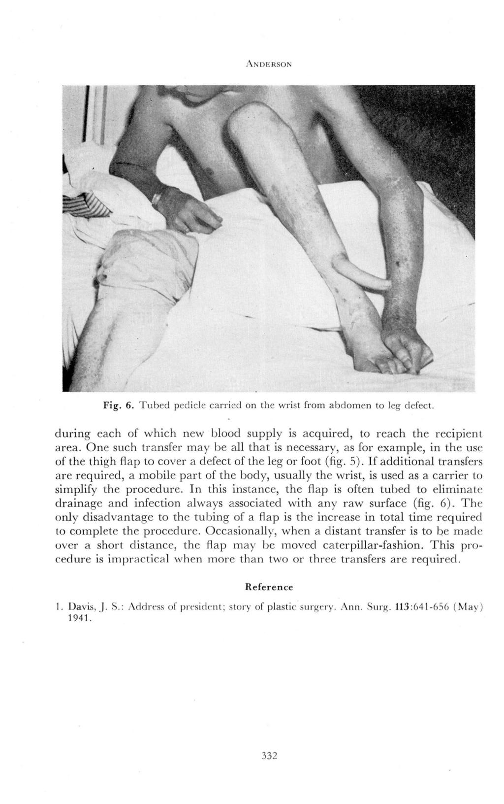 ANDERSON Fig. 6. Tubed pedicle carried on the wrist from abdomen to leg defect. during each of which new blood supply is acquired, to reach the recipient area.