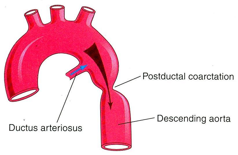 Coarctation of Aorta Male : Female 2:1