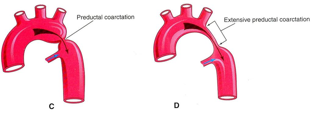 Preductal coarctation Ductus arteriosus Closure of DA in infant results in hypoperfusion and