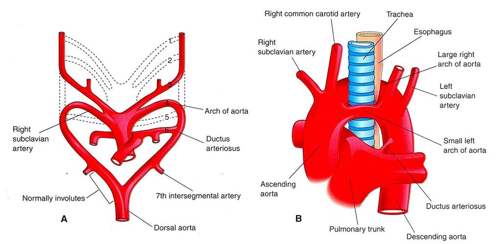 Double Aortic Arch Vascular ring around the trachea and esophagus