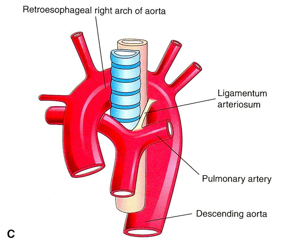Retroesophageal right arch