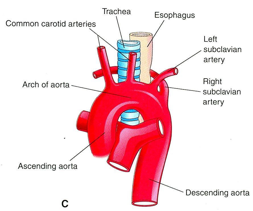 Anomalous Right Subclavian Artery Abnormal involution Persistent portion