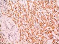 TIMP 1 expression* Carcinoma cells Peritumoural fibroblasts Parameters Total N % p value Total N % p value Age <50 6 4 15,4 0,005 ( ) 6 4 19,0 0,595 ( ) >50 22 22 84,6 0,006 ( ) 22 17 81,0 0,602 ( )