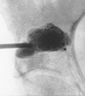 osteolytic metastasis of the acetabular roof (a), injection of the lesion with acrylic cement containing tungsten powder to increase its