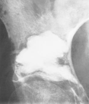 ence of cortical destruction or fracture (especially of the acetabular roof and acetabular fossa), and the presence of soft-tissue