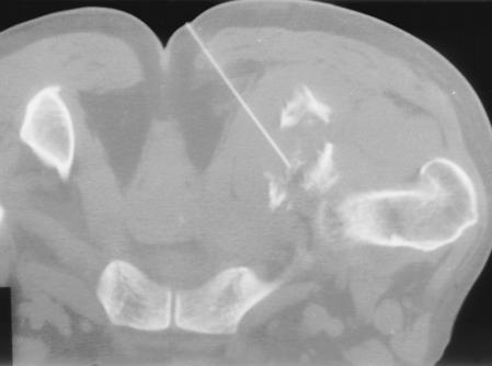(4) CT scan shows injection of contrast material into an osteolytic lesion of the right posterior acetabulum.