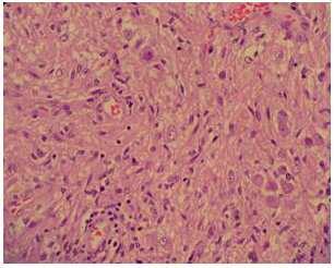 Histology of Primary Brain Tumors http://dx.doi.org/10.5772/52356 167 plastic glial cells of varying proportions.