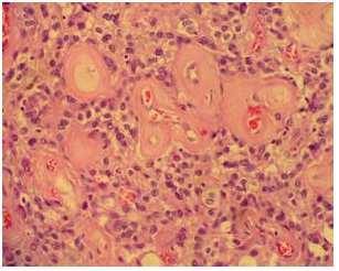 Histology of Primary Brain Tumors http://dx.doi.org/10.5772/52356 173 2.6. Other neuroepithelial tumors a.