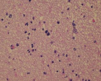 membranous accentuation; an important discriminating point from mini-gemistocytes seen in oligodendroglioma (see below).