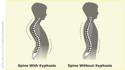 Artikel from KidsHealt.org What Is Kyphosis? Kyphosis is a fairly common condition for teens and adults.