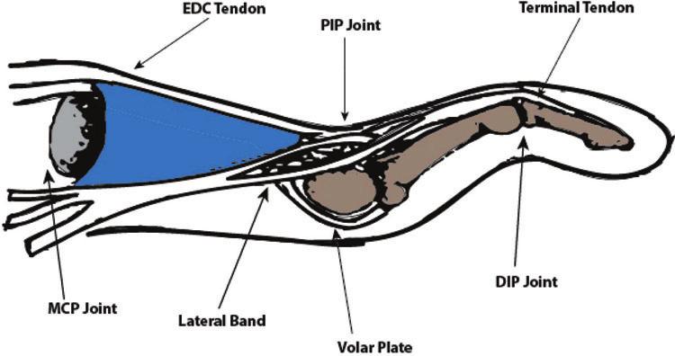 DISCUSSION Swan-neck deformities are defined by hyperextension of the PIP joint and flexion of the distal interphalangeal (DIP) joint (Fig 1).