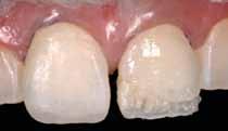 Excellent polishability in few steps. Brilliant surfaces that blend in with the adjacent dental substrate.» Prof.