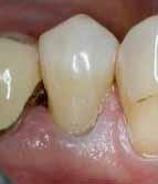 Pre-operative view BRILLIANT Flow application Final restoration Source: Internal data One Coat Bond SL: Just one drop Just one coat A powerful adhesive for dentine and enamel The hydrophilic nature