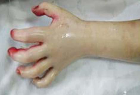 348 Cristina A. Avram et al Figure 3. Left hand third degree flame burn with compartment syndrome Figure 4.