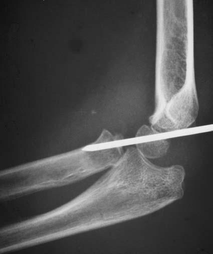 Figure 2a Anteroposterior and lateral radiographs showing a normal proximal radius and capitellum with no radial lengthening.