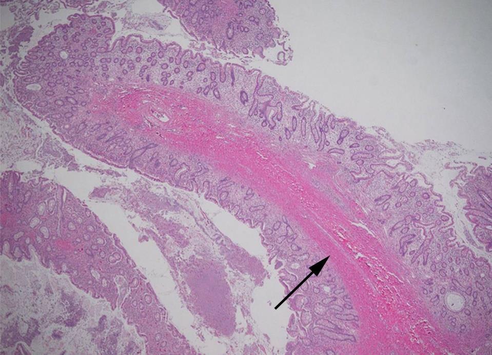 fissure-like ulceration, and the perforation of the colonic wall