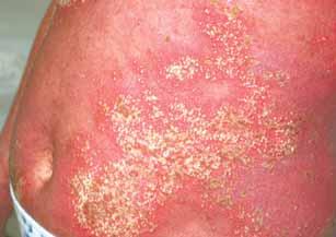 are scattered among keratinocytes at the periphery) consistent with pustular psoriasis or impetigo herpetiform.