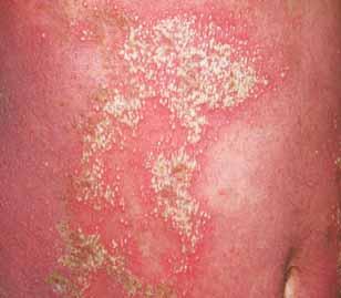 The eruption is usually associated with symptoms such as pain, fever, chills, vomiting, nausea, diarrhea, seizures,