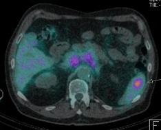 scan showing radioactivity uptake in tumours 9 ICML