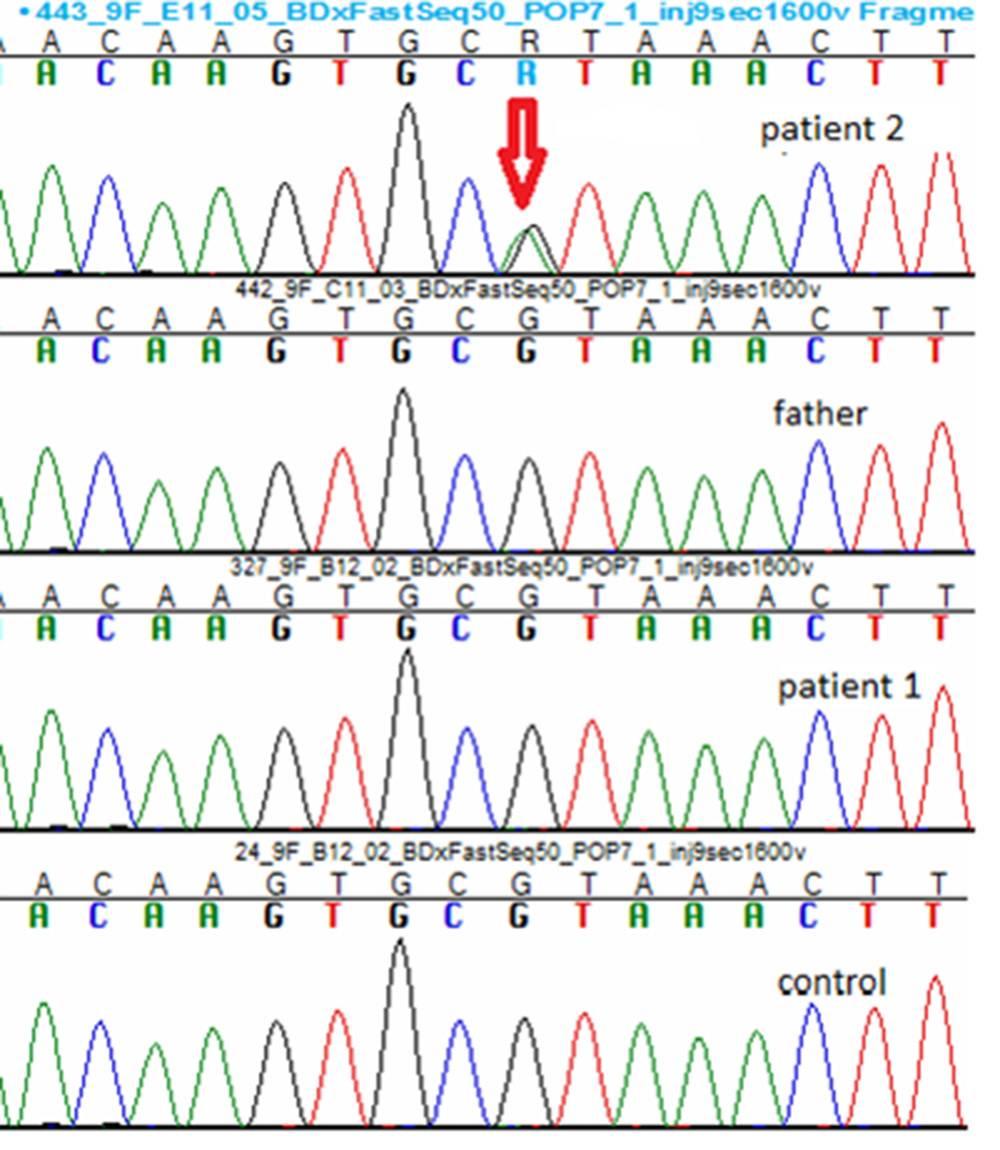 316 Revista Română de Medicină de Laborator Vol. 22, Nr. 3, Septembrie, 2014 Figure 3. Sequencing chromatogram of the WT1 gene in the donor splice-site of intron 9: c.
