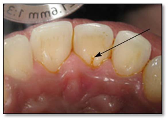 initial periodontal therapy, consisting of scaling and root planning, was carried out. The patient was instructed in proper oral hygiene measures.