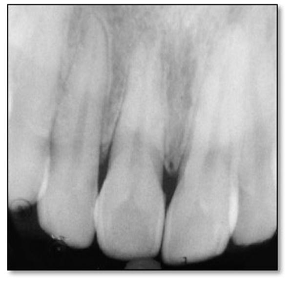 groove ended at the cemento-enamel junction (CEJ) (Figure 4). Figure 2. Mirror view of the radicular groove in the mid-palatal aspect of the maxillary right central incisor. Figure 3.