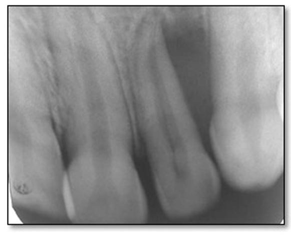 incisor after root canal treatment. Figure 6.