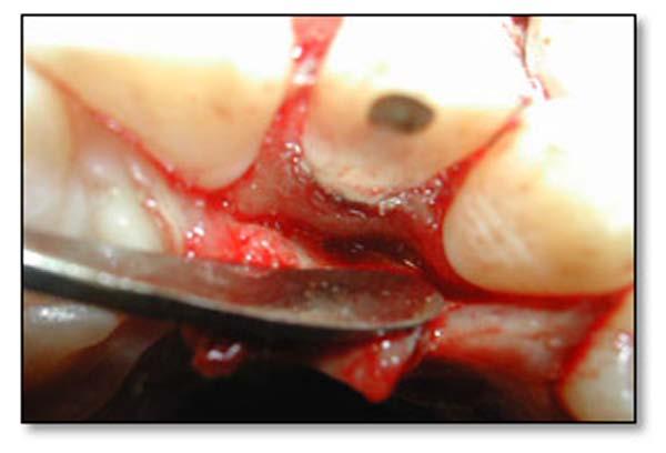 Due to extensive loss of bone, additive osseous surgery involving placement of a bone graft was carried out.