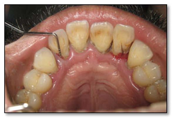 Healing was satisfactory, and the patient was put on supportive periodontal therapy.
