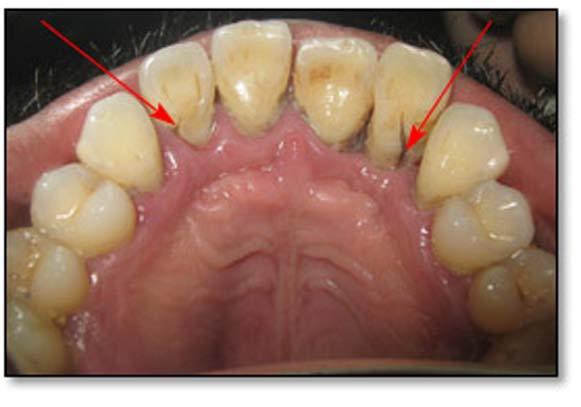 the affected lateral incisors extracted and then the missing teeth replaced. Discussion Figure 15.