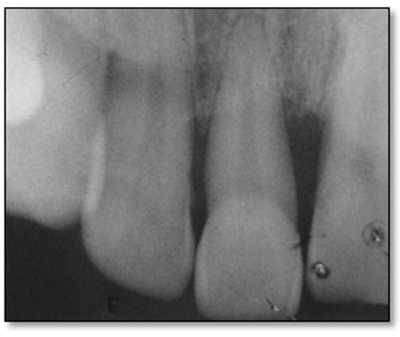 Periapical radiograph showing severe maxillary anterior bone loss. Figure 17. Periapical radiograph showing extensive bone loss around the maxillary right lateral incisor.