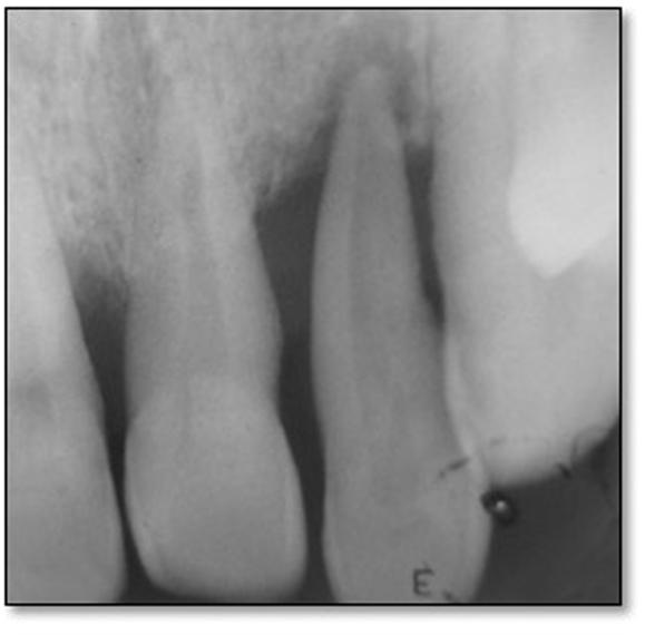 In the first case, the patient was a young lady with moderate periodontal pocket depth and minimal destruction of the attachment apparatus.