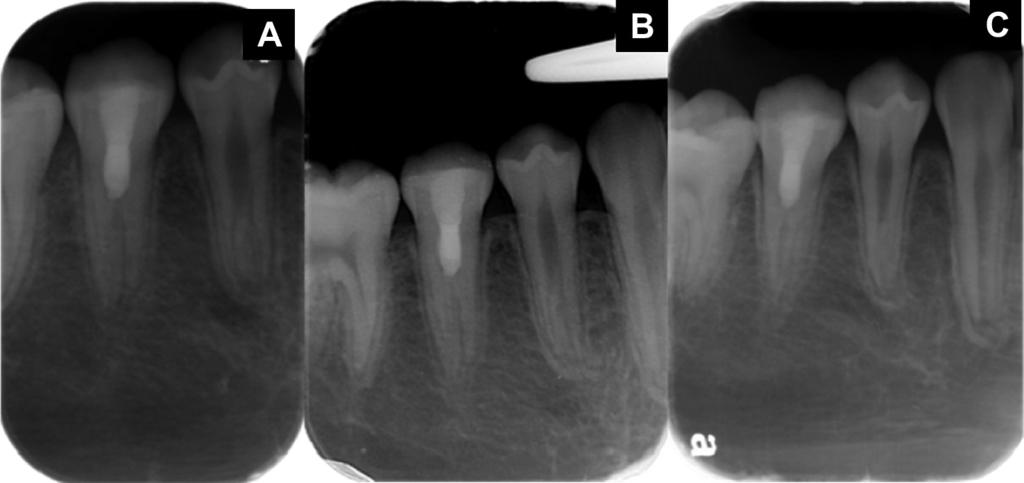 3C) followup examinations, the patient remained asymptomatic. The radiographs demonstrated evidence of continual development of the tooth apex.