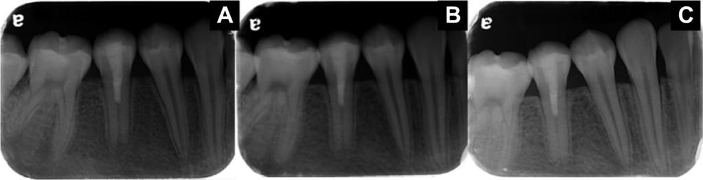 (C) Radiograph showing the sinus tract tracing to the periradicular radiolucency of tooth 29.