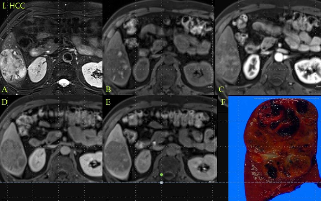 Fig. 8: Pathologically confrimed HCC patient, a 7cm sized, lobulated mass lesion in hepatic angle: A. High SI on T2WI B.