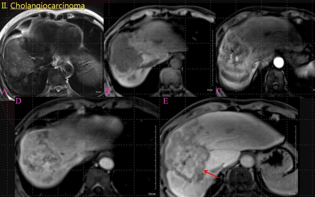 Fig. 9: A patient with pathologically confirmed cholangiocarcinoma: A.